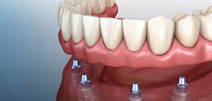 Broken Tooth Treatment Goregaon